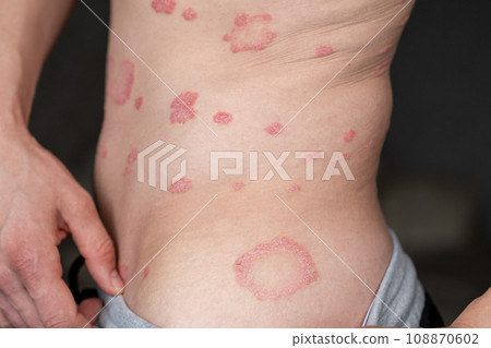 Psoriasis Vulgaris, skin patches are typically red, itchy, and scaly. Papules of chronic psoriasis vulgaris on male hand, back and body. Genetic immune disease. Detail of psoriatic skin disease  108870602