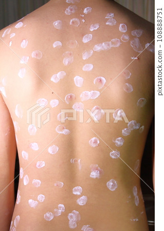 Because of a rash caused by chickenpox, an anti-inflammatory and anti-pruritic drug was applied to the affected area. 108888751