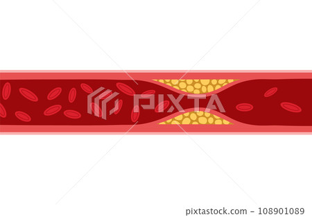 Cholesterol artery thrombosis micro vascular disease. Arteriosclerosis blood vector atherosclerosis Cholesterol artery thrombosis micro vascular disease. Arteriosclerosis blood vector atherosclerosis 108901089