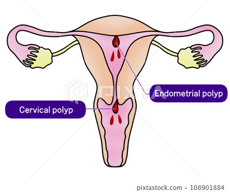 Illustration of endometrial polyp and cervical polyp 108901884