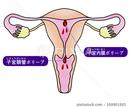 Illustration of endometrial polyp and cervical polyp 108901885