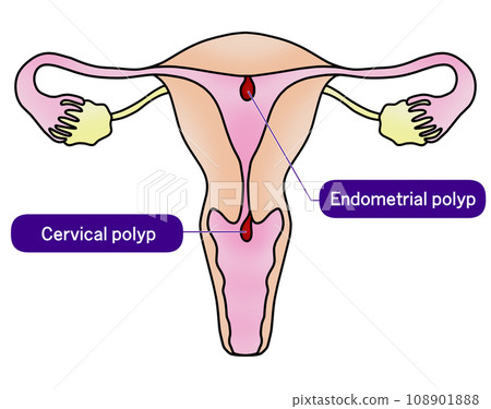 子宮內膜息肉與子宮頸息肉圖解 108901888