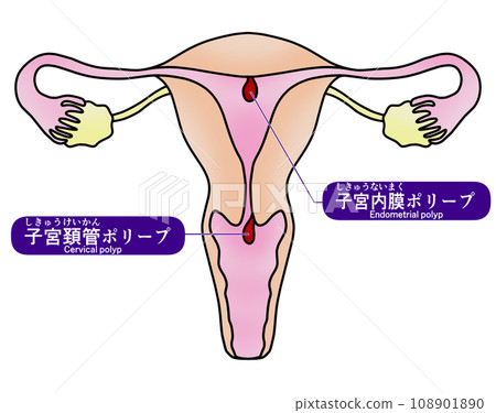 Illustration of endometrial polyp and cervical polyp 108901890