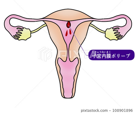 子宮內膜息肉與子宮頸息肉圖解 108901896