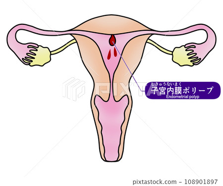 子宮內膜息肉與子宮頸息肉圖解 108901897