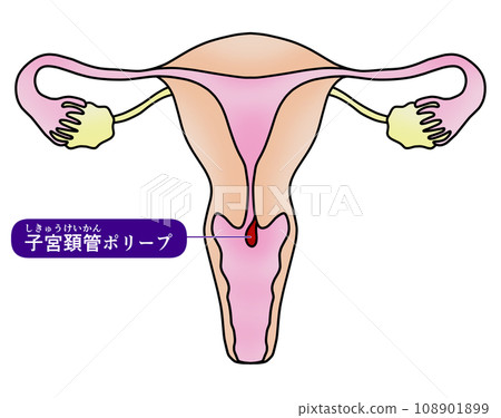 子宮內膜息肉與子宮頸息肉圖解 108901899