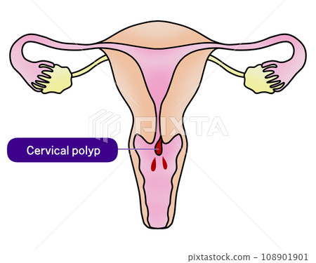 子宮內膜息肉與子宮頸息肉圖解 108901901