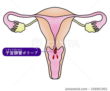 子宮內膜息肉與子宮頸息肉圖解 108901902