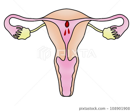 子宮內膜息肉與子宮頸息肉圖解 108901908