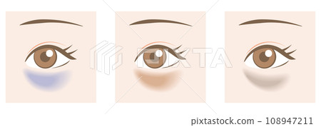 Types of dark circles 108947211