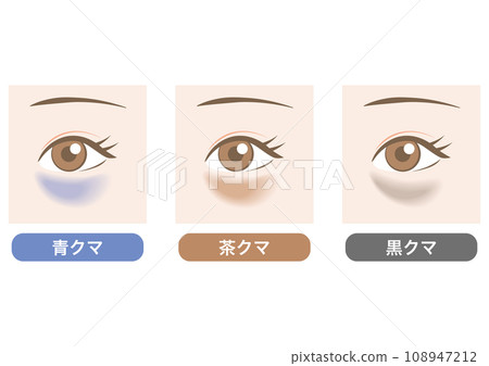 黑眼圈的類型 108947212