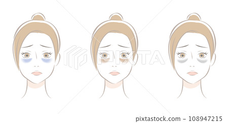 黑眼圈的類型 108947215