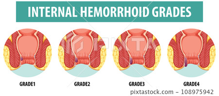 Anatomy of Human Internal Hemorrhoid in Different Grades Anatomy of Human Internal Hemorrhoid in Different Grades 108975942
