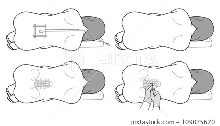 Illustration of epidural anesthesia, subarachnoid anesthesia, and painless childbirth Illustration of epidural anesthesia, subarachnoid anesthesia, and painless childbirth 109075670