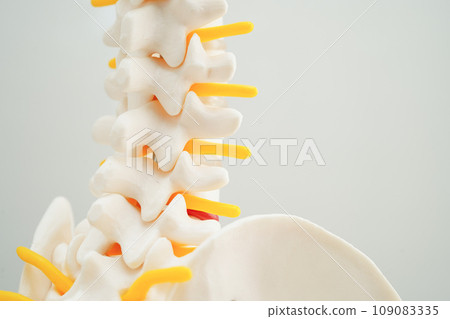 Spinal nerve and bone, Lumbar spine displaced herniated disc fragment, Model for treatment medical in the orthopedic department. 109083335