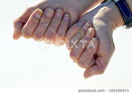 Fungal nail infection, onycholysis after shellac or gel-varnish Fungal nail infection, onycholysis after shellac or gel-varnish 109106973