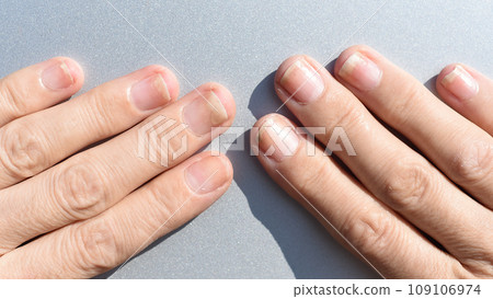 Fungal nail infection, onycholysis after shellac or gel-varnish Fungal nail infection, onycholysis after shellac or gel-varnish 109106974