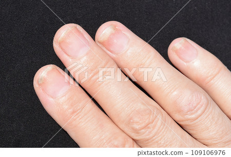 Fungal nail infection, onycholysis after shellac or gel-varnish Fungal nail infection, onycholysis after shellac or gel-varnish 109106976