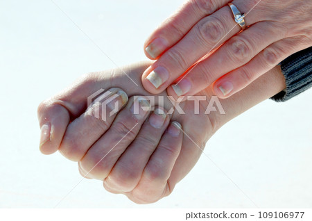 Fungal nail infection, onycholysis after shellac or gel-varnish Fungal nail infection, onycholysis after shellac or gel-varnish 109106977