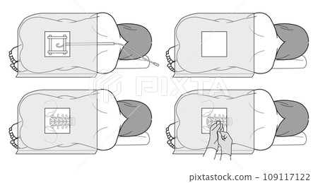 硬脊膜外麻醉、蜘蛛網膜下腔麻醉、無痛分娩、剖腹產、麻醉、注射、麻醉科醫師、插圖 109117122