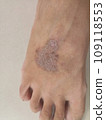 rash eczema dermatitis  on foot. inflammation of skin 109118553