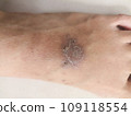 rash eczema dermatitis  on foot. inflammation of skin 109118554