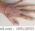 rash eczema dermatitis  on finger hand. inflammation of skin 109118555