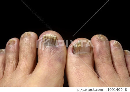 趾甲真菌特寫 趾甲真菌特寫 109140948