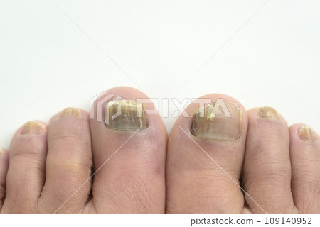 趾甲真菌特寫 109140952