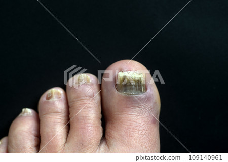 Close-up of toenail fungus 109140961