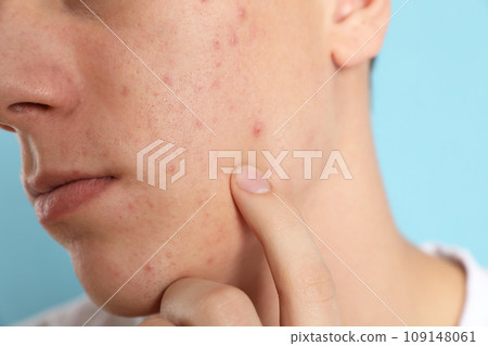 Teen guy with acne problem on light blue background, closeup 109148061