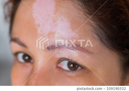Close-up of a woman with autoimmune pigmentation disease vitiligo Close-up of a woman with autoimmune pigmentation disease vitiligo 109190332