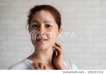 Vitiligo. Portrait of a beautiful smiling woman with lack of skin pigmentation on her forehead. A girl with a white spot on her face. Autoimmune disease. Vitiligo. Portrait of a beautiful smiling woman with lack of skin pigmentation on her forehead. A girl with a white spot on her face. Autoimmune disease. 109191542