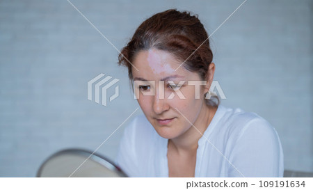 Portrait of a Caucasian woman with vitiligo. A girl with a white pigment spot on her forehead looks in the mirror. An autoimmune disease affecting the skin. 109191634