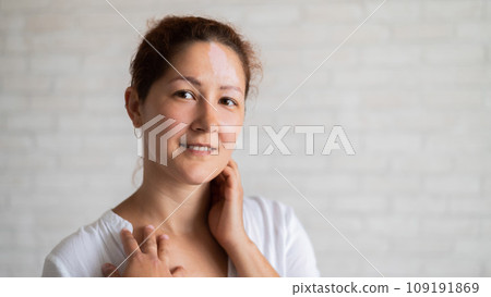 Vitiligo. Portrait of a beautiful smiling woman with lack of skin pigmentation on her forehead. A girl with a white spot on her face. Autoimmune disease. Vitiligo. Portrait of a beautiful smiling woman with lack of skin pigmentation on her forehead. A girl with a white spot on her face. Autoimmune disease. 109191869