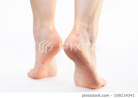 Rear view of female feet with peeling skin on heels, on white background. Skin care and peeling leg's soles Rear view of female feet with peeling skin on heels, on white background. Skin care and peeling leg's soles 109214341