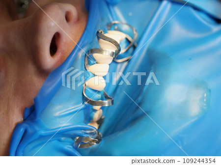 Patient at dentist office to install dentures or veneers closeup 109244354
