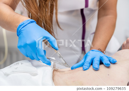Nurse removing surgical stitches from the abdomen of a patient following surgical intervention. 109279635