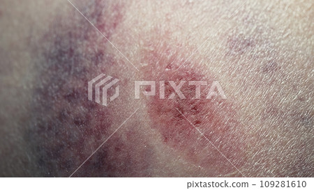 Big bruise hematoma after hit on human body skin. Congestion, macro. Health injury, pain, trauma 109281610