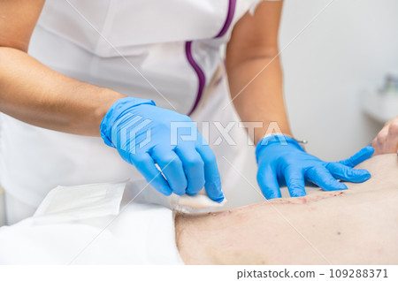 hand of Doctor is using clean cotton dressing infection wound at a man abdomen. Bandage for wound hand of Doctor is using clean cotton dressing infection wound at a man abdomen. Bandage for wound 109288371