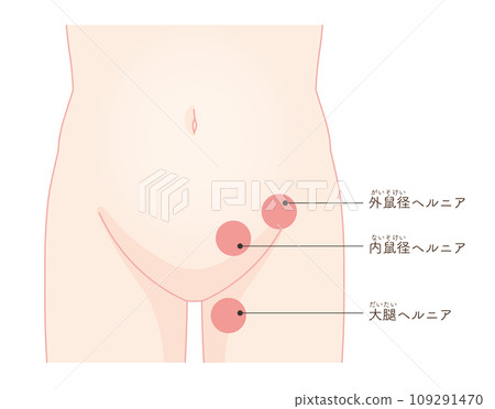 Hernia, inguinal hernia, groin, hip joint, pelvis, muscle, illustration, illustration 109291470