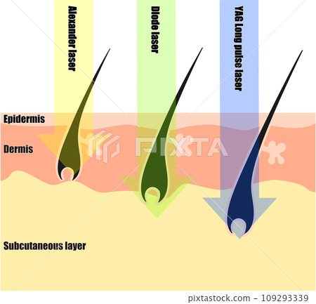 在皮膚橫截面視圖中看到的除毛雷射的差異 109293339