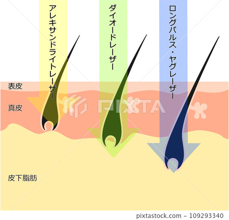 在皮膚橫截面視圖中看到的除毛雷射的差異 在皮膚橫截面視圖中看到的除毛雷射的差異 109293340