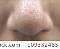 Skin concerns: Strawberry nose clogged with keratin plugs 109332485