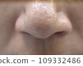 Skin concerns: Strawberry nose clogged with keratin plugs 109332486
