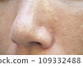 Skin concerns: Strawberry nose clogged with keratin plugs 109332488