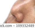 Skin concerns: Strawberry nose clogged with keratin plugs 109332489