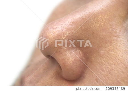 皮膚問題:草莓鼻被角蛋白塞堵塞 皮膚問題:草莓鼻被角蛋白塞堵塞 109332489