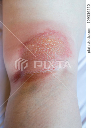 eczema dermatitis behind knee closeup eczema dermatitis behind knee closeup 109336250