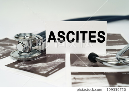 On the ultrasound pictures there is a stethoscope and a business card with the inscription - Ascites 109359750